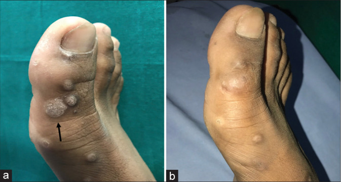 Intralesional immunotherapy of cutaneous warts using tuberculin purified protein derivative and vitamin D<sub>3</sub> - A randomized comparative study.