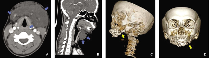 A Case of Vanishing Mandible: Diagnosis and Treatment Considerations for Gorham-Stout Disease of the Mandible.