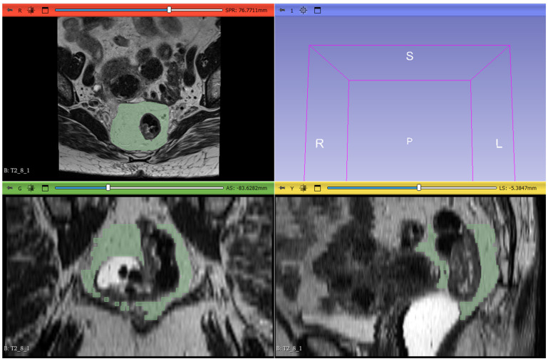 Radiomic Features of Mesorectal Fat as Indicators of Response in Rectal Cancer Patients Undergoing Neoadjuvant Therapy.