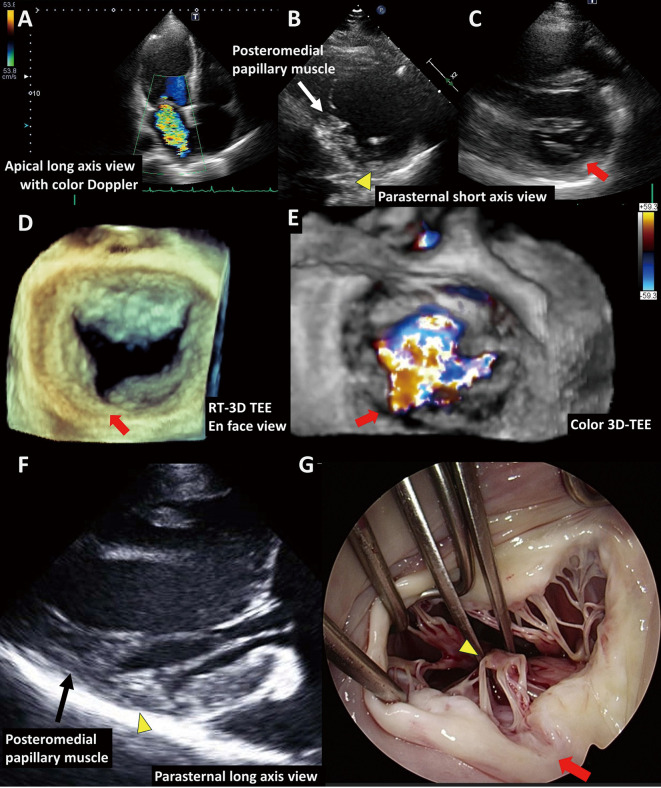 Isolated Cleft of the Posterior Mitral Valve Leaflet With Papillary Muscle Abnormalities.