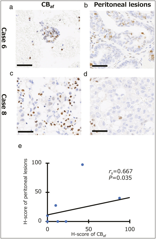 Evaluation of Platinum Resistance or Sensitivity Markers by Analysis of Cell Block Specimens of Ascites Fluid in High-Grade Serous Carcinoma.