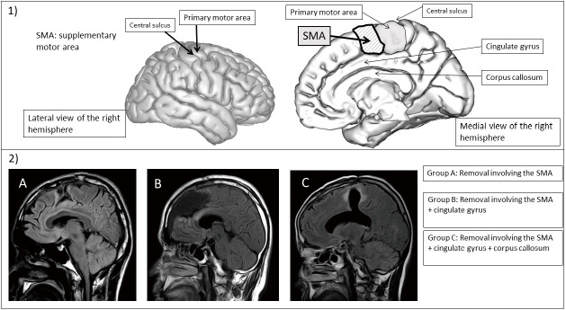 Severity of Clinical Symptoms of Supplementary Motor Area Syndrome Correlates with the Extent of Tumor Resection in the Brain.