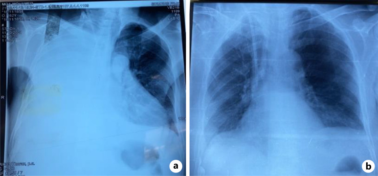 Pleuroperitoneal Leak: A Rare Complication of Peritoneal Dialysis.