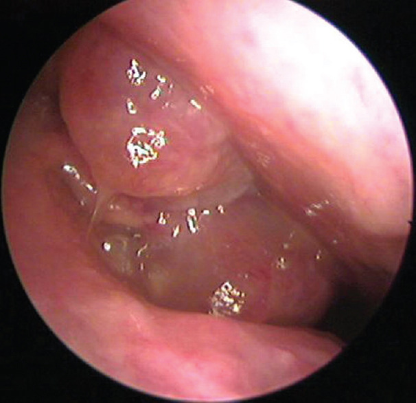 Comparison of Intraoperative Efficacy of Preoperative Single-Dose Corticosteroid Over Short Course in Functional Endoscopic Sinus Surgery for Nasal Polyposis.
