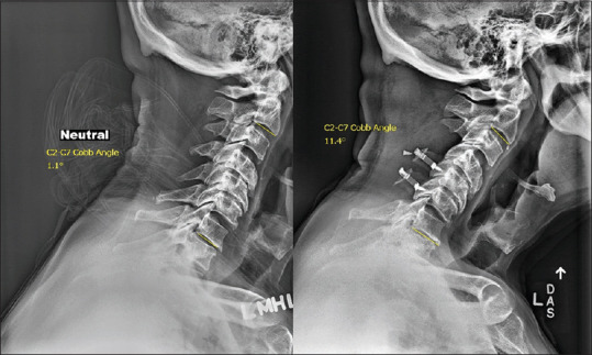 Frailty index as predictors of loss of cervical lordosis following laminoplasty in patients with cervical spondylotic myelopathy.