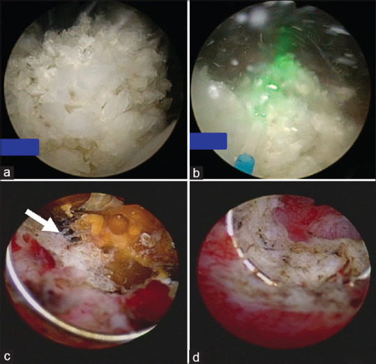 How to Deal with Bladder Stones Associated with Exposed Intravesical Mesh.
