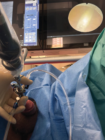 Endoscopic Removal of Superglue From the Urethra: A Case Report and Review of the Literature.