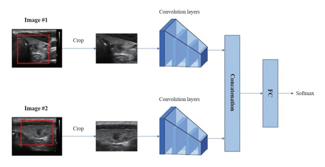 Deep Learning Technology for Classification of Thyroid Nodules Using Multi-View Ultrasound Images: Potential Benefits and Challenges in Clinical Application.