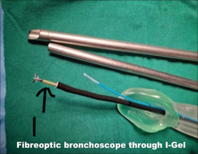 An Alternate Approach to Anesthetic Management of Central Airway Tumors.