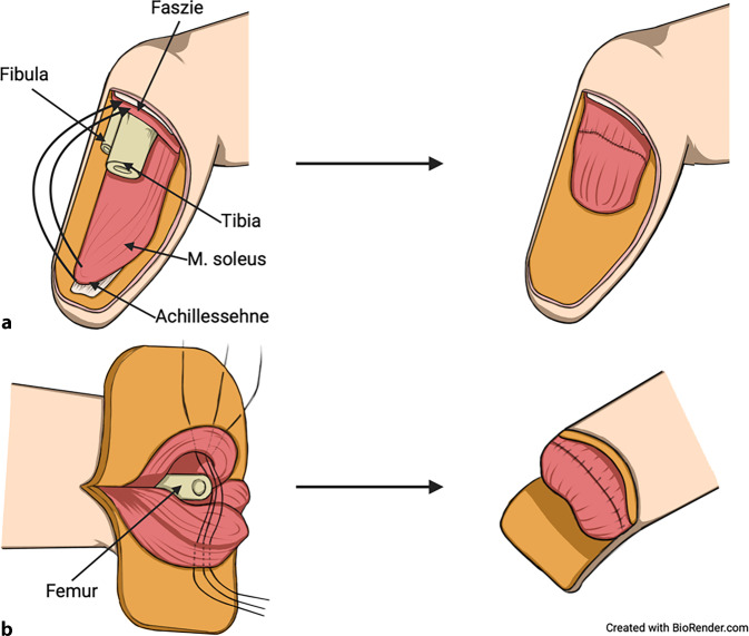 [Agonist-antagonist myoneural interface (AMI) : Innovative treatment option for lower limb amputees?]