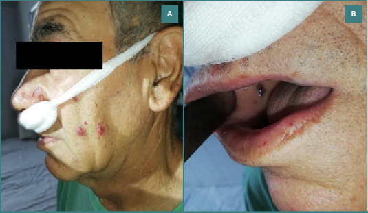 Rendu-Osler disease, a cause of recurrent epistaxis: a case report.