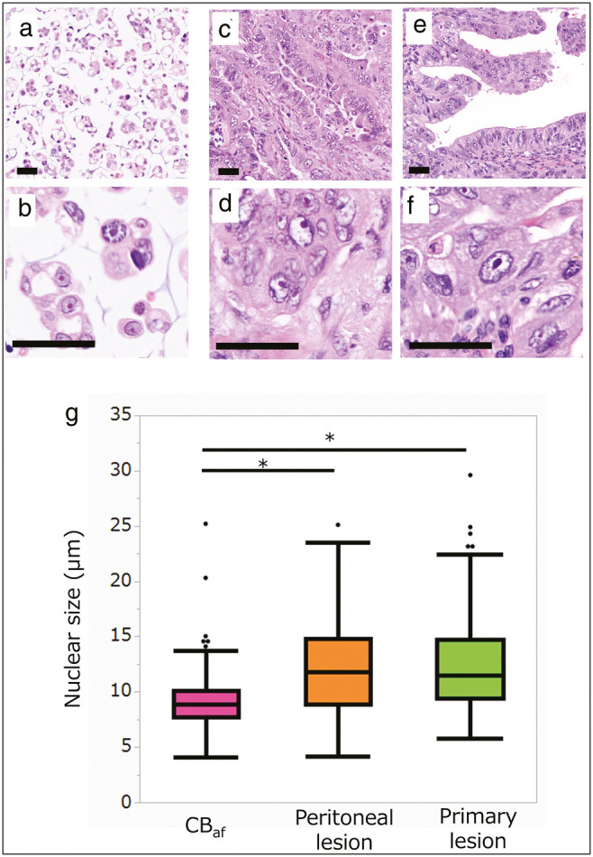 Evaluation of Platinum Resistance or Sensitivity Markers by Analysis of Cell Block Specimens of Ascites Fluid in High-Grade Serous Carcinoma.