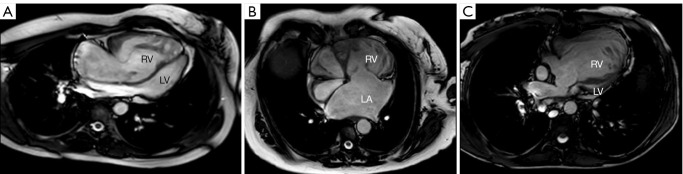 Initial outcomes of novel guideline-directed pharmacotherapy for systemic right heart failure in adults with congenital heart disease.