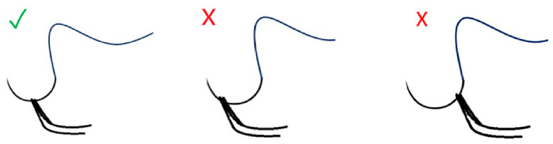 Microvascular Anastomosis in Practice: A Pilot Study on Microsurgical Training Efficiency.
