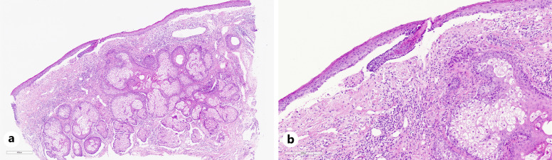Therapy-Resistant Erosions in the Genital Area of Elderly Patients: A Differential Diagnostic Challenge - A Case Report.