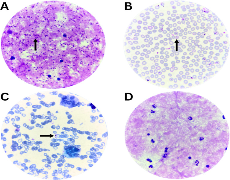 Managing Acute Kidney Injury in Severe <i>Falciparum</i> Malaria: Insights from a Challenging Case.