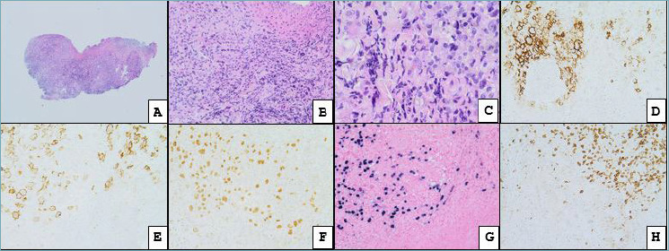 Head and neck hematolymphoid proliferations: what is new?