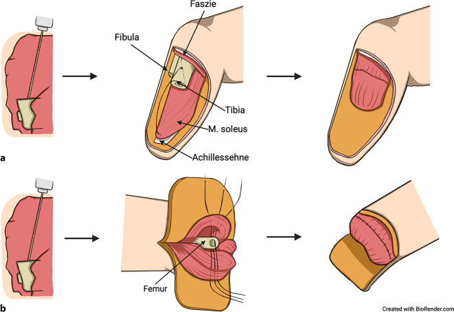 [Agonist-antagonist myoneural interface (AMI) : Innovative treatment option for lower limb amputees?]