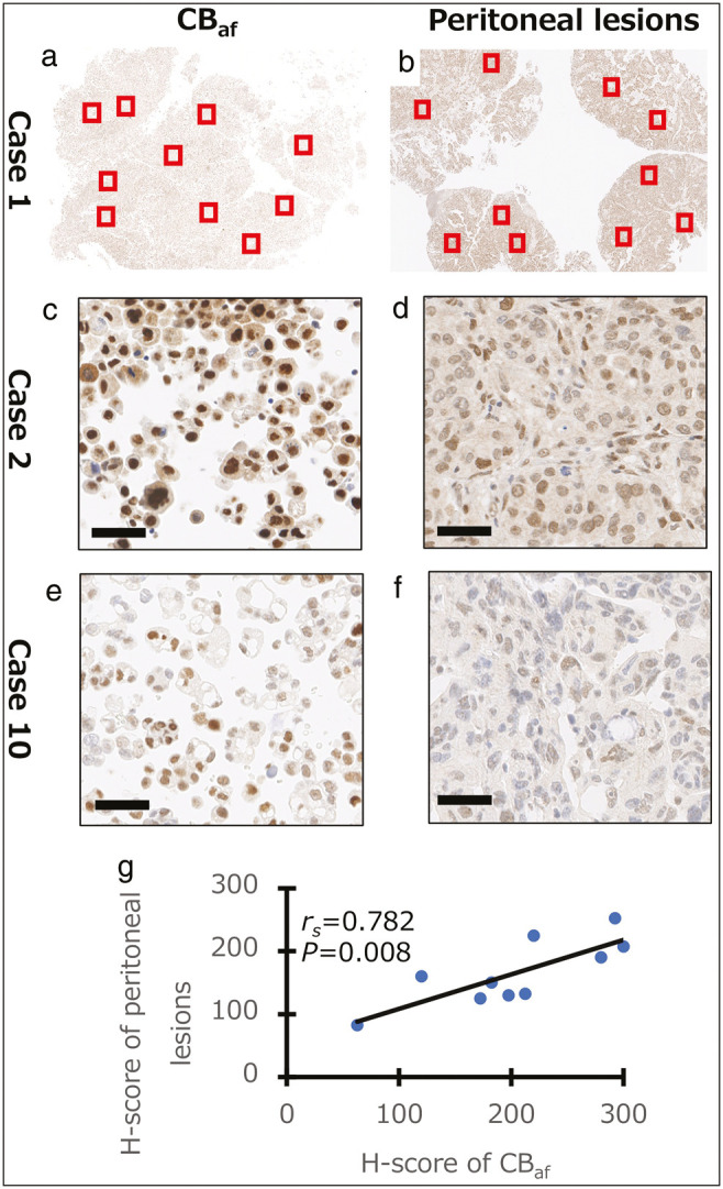 Evaluation of Platinum Resistance or Sensitivity Markers by Analysis of Cell Block Specimens of Ascites Fluid in High-Grade Serous Carcinoma.