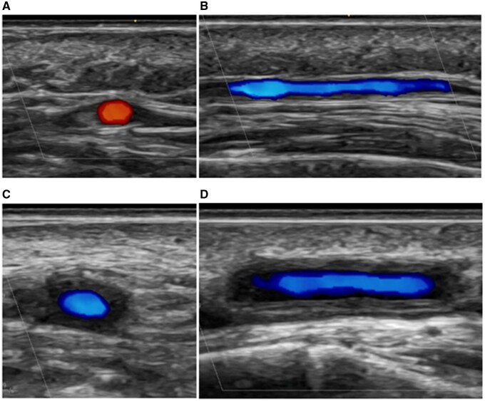 AI for imaging evaluation in rheumatology: applications of radiomics and computer vision-current status, future prospects and potential challenges.