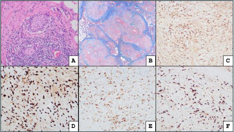 Head and neck hematolymphoid proliferations: what is new?