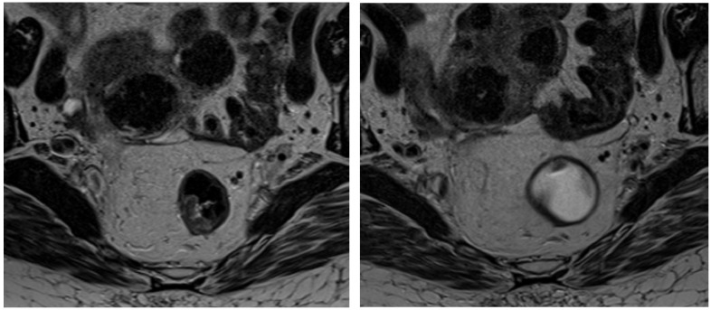 Radiomic Features of Mesorectal Fat as Indicators of Response in Rectal Cancer Patients Undergoing Neoadjuvant Therapy.