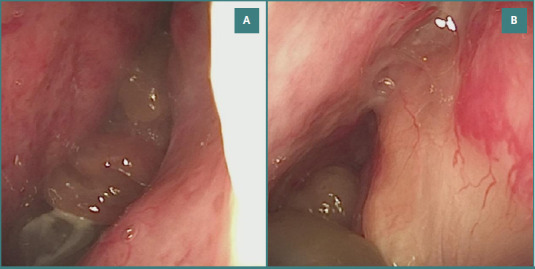 Rendu-Osler disease, a cause of recurrent epistaxis: a case report.