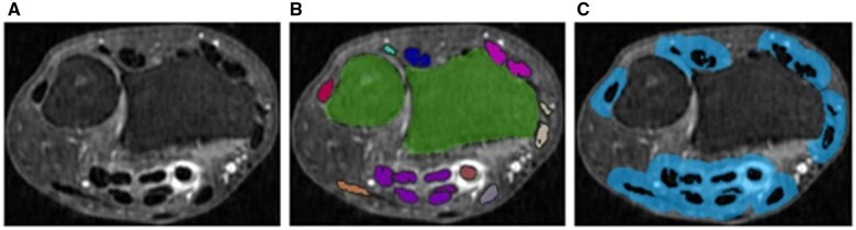 AI for imaging evaluation in rheumatology: applications of radiomics and computer vision-current status, future prospects and potential challenges.