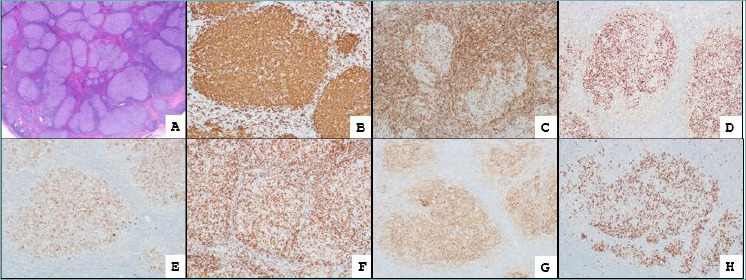 Head and neck hematolymphoid proliferations: what is new?