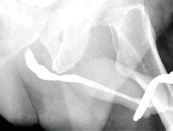Endoscopic Removal of Superglue From the Urethra: A Case Report and Review of the Literature.