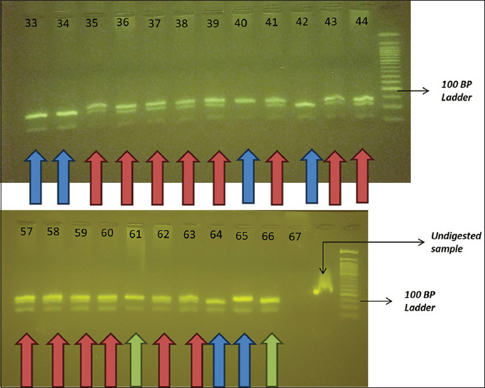 Does beta-2 ADR polymorphism influence the degree of postspinal hypotension in obstetric patients?