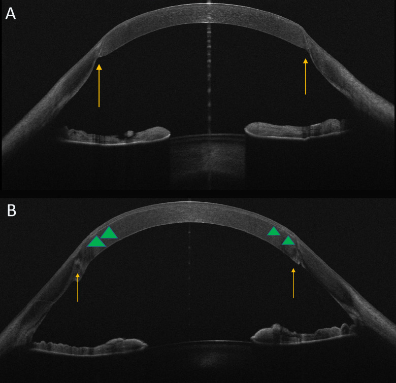 Femtosecond laser-assisted <i>in situ</i> keratomileusis for the correction of residual ametropia after penetrating keratoplasty: 1-year follow-up.