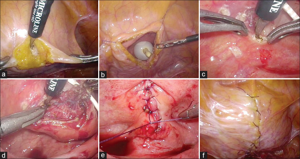 How to Deal with Bladder Stones Associated with Exposed Intravesical Mesh.