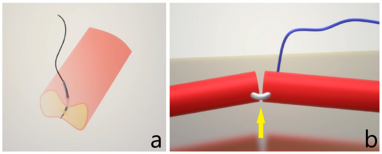 Microvascular Anastomosis in Practice: A Pilot Study on Microsurgical Training Efficiency.