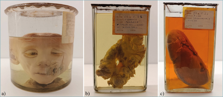A 20th century case of noma infection following typhoid fever from the Morgagni Museum (Padua, Italy).