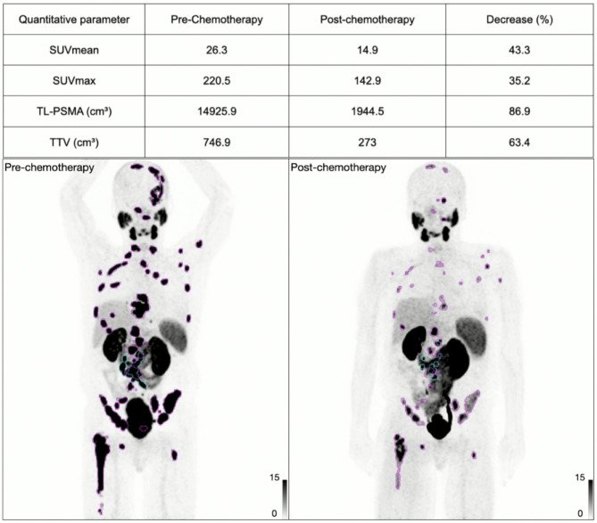 Pre- or post-chemotherapy: effect on PSMA uptake.