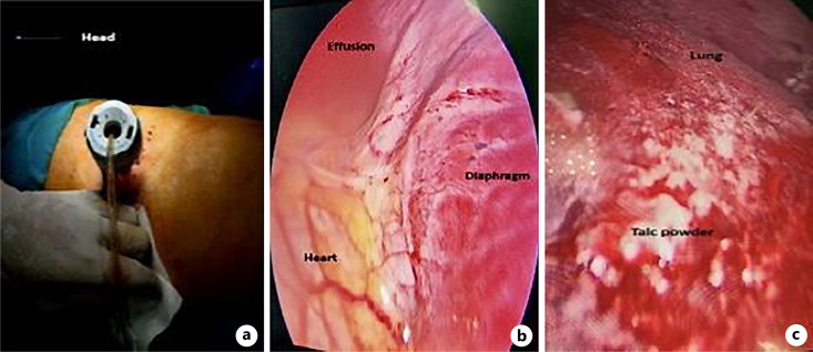 Pleuroperitoneal Leak: A Rare Complication of Peritoneal Dialysis.