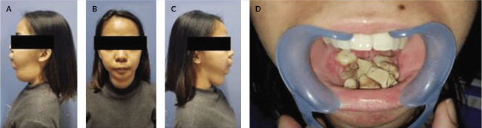A Case of Vanishing Mandible: Diagnosis and Treatment Considerations for Gorham-Stout Disease of the Mandible.