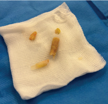 Endoscopic Removal of Superglue From the Urethra: A Case Report and Review of the Literature.