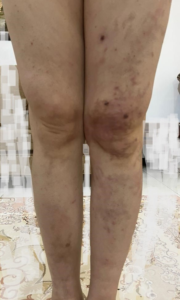 Effective Pain Management in Polyarteritis Nodosa (PAN) Utilizing Lumbar Sympathetic Blocks: A Case Report.