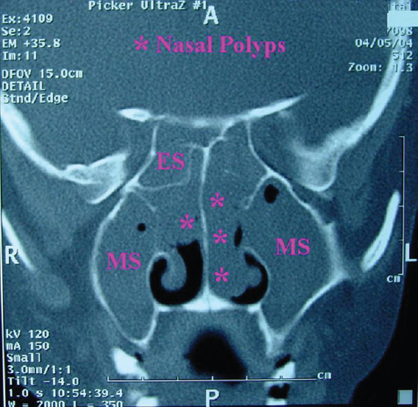Comparison of Intraoperative Efficacy of Preoperative Single-Dose Corticosteroid Over Short Course in Functional Endoscopic Sinus Surgery for Nasal Polyposis.