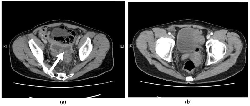 Neovaginal Perforation in Sigmoid Vaginoplasty: An Underrecognized Complication-A Literature Review.
