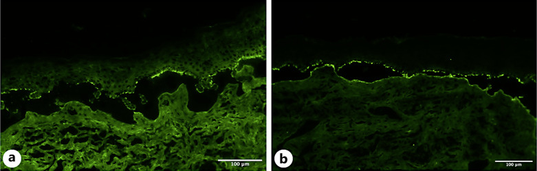 Therapy-Resistant Erosions in the Genital Area of Elderly Patients: A Differential Diagnostic Challenge - A Case Report.