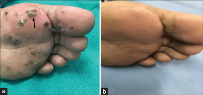 Intralesional immunotherapy of cutaneous warts using tuberculin purified protein derivative and vitamin D<sub>3</sub> - A randomized comparative study.