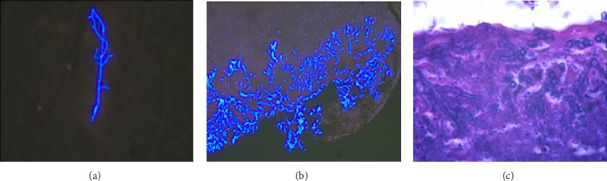 A Case Report of COVID-19 With Tracheobronchial Aspergillosis.