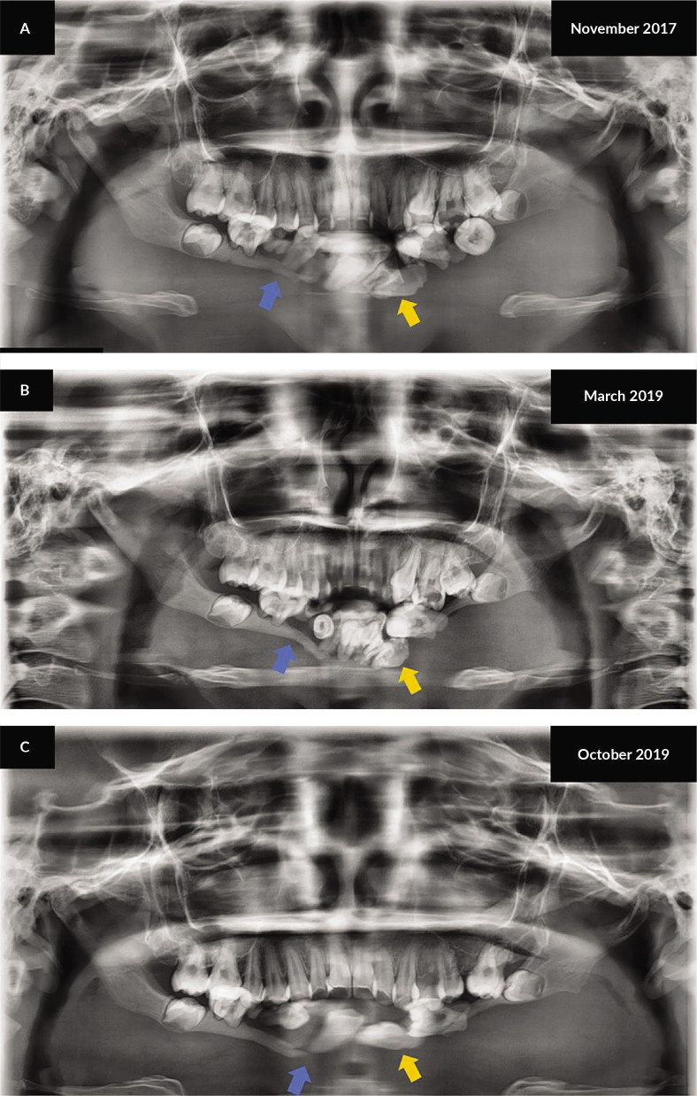 A Case of Vanishing Mandible: Diagnosis and Treatment Considerations for Gorham-Stout Disease of the Mandible.