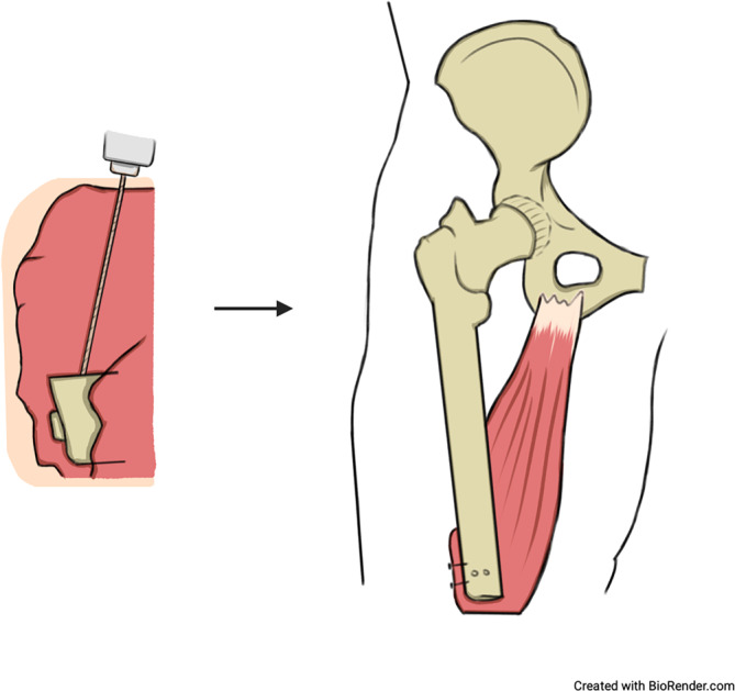 [Agonist-antagonist myoneural interface (AMI) : Innovative treatment option for lower limb amputees?]