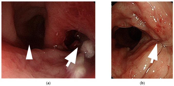 Neovaginal Perforation in Sigmoid Vaginoplasty: An Underrecognized Complication-A Literature Review.