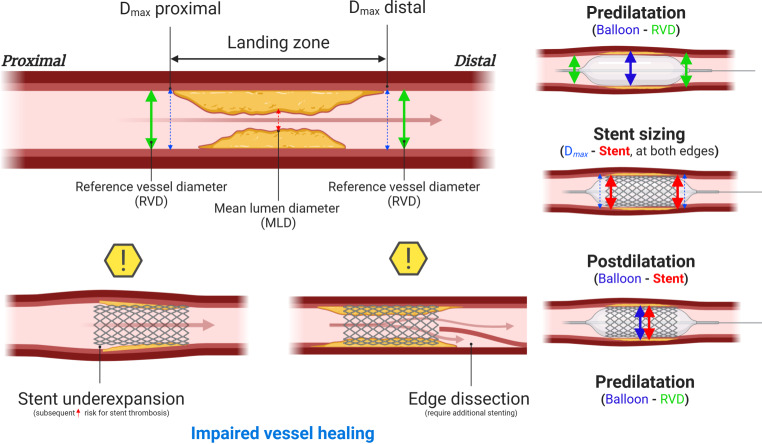 Impact of lesion preparation and stent optimisation on lesion-oriented events in PCI with drug-eluting stents: 5-year results from the AIDA trial.