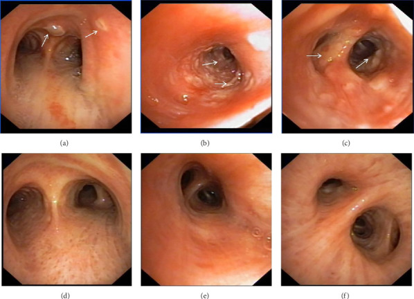 A Case Report of COVID-19 With Tracheobronchial Aspergillosis.